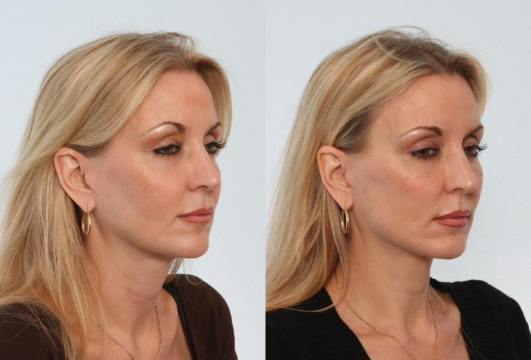 All About Neck Lift Pricing, Procedure, Eligibility, And More