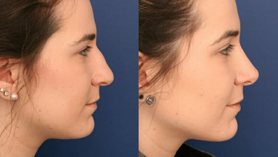 Rhinoplasty