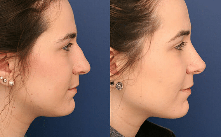 Rhinoplasty